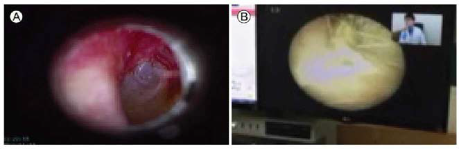 비대면 진료 환경에서 동일한 부위를 촬영한 2개의 영상 (출처 : 김종엽 • 이관익, 2020) *Multifunction medical Camera. (A) Patient´s external auditory canal photo taken with a multifunctional camera considering in telemedicine environment. (B) Patient´s external auditory canal photo taken with a regular multifunctional camera
