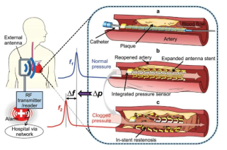 LC 공진 수동 혈류 센서를 활용한 스텐트 혈관 재협착 모니터링 시스템 (Chen et al, 2018)