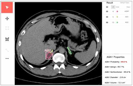 부신 결절의 자동 진단 툴 개발 prototype