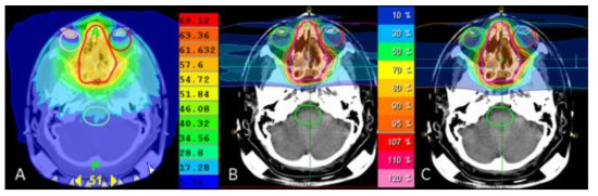 Photon IMRT(A), Carbon ion(B), proton(C) 치료 효과 비교