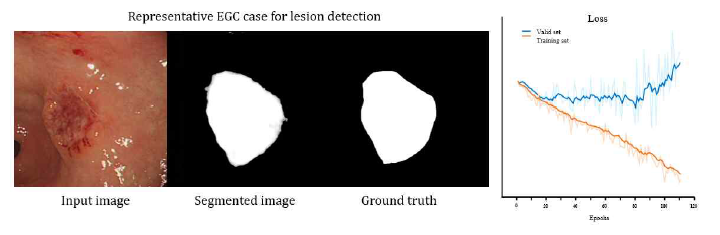 위내시경 영상 병변 자동 구획화 (lesion segmentation) 대표적 예시 (representative case): (좌, 왼쪽부터) 입력 이미지, 구획화된 출력 이미지, 그리고 실제 구획화 이미지. (우) 학습 과정 중의 학습 (training) 및 검증 (validation) 데이터셋에서의 손실 함수 (loss function). 과적합(overfitting)을 막기 위해 검증 손실 (validation loss)이 가장 낮은 에포크(epoch)에서 조기 학습 종료(early stopping)를 시행함