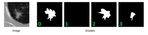LIDC 데이터셋 이미지 [2, 3]로서 원본 흉부CT이미지(좌측)와 총 네 명의 의사로부터 얻은 이미지 분할 레이블 (우측)