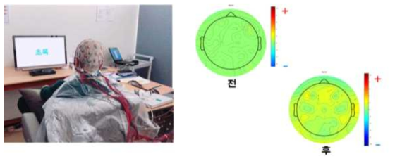 뇌 기능 영상 촬영을 통한 대뇌 활성도 측정