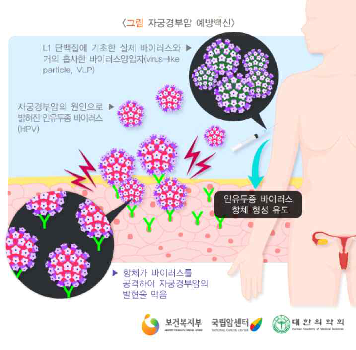 바이러스 유사입자 자궁경부암백신