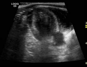 초음파 소견 양호 (cardiac graft 기능 우수. 좌심실 수축력 양호 (LV EF 65%), 주변 삼출물 없음