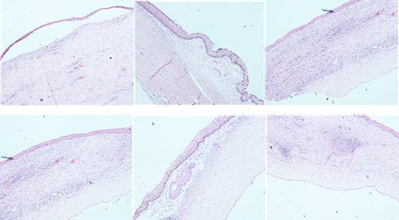각막 27-06 개체 POD56 종료 - corneal epithelium이 불규칙하게 얇아져 있음 - subepithelial vesicle, edema 관찰 - stroma 앞부분으로 stromal neovascularization 매우 심하게 나타남 - 다양한 종류의 염증세포 (lymphocytes, neutrophils, eosinophils)가 침윤 - Lymphoid nodule을 형성을 보이기도 함 - Foreign-body type giant cell이 나타나고 있음 - corneal endothelial cell이 불규칙한 discontinuity를 보이고 있음