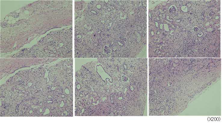 POD67 바이옵시 - No histologic evidence of allograft rejection - Tubular atrophy and sloughing of tubular epithelial cells, suggestive of acute tubular necrosis - “obstructive” glomerular changes (crowded appearance, small size, mild collapse, wrinkling of glomerular capillaries, enlarged urinary spaces) - Tubulointerstitial inflammation with lymphocytes and neutrophils infiltration - Fibrous adhesion to perirenal soft tissue