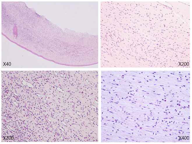 POD21 - Irregular attenuation of epithelial layer, stromal neovascularization with congestion and profound polymorphic inflammatory infiltrations including lymphocytes, plasma cells, eosinophils, neutrophils are present