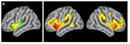 probability map of the functionally segmented anterior insular subregions