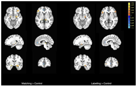 Matching 및 Labelling 조건에서 주요우울장애군 뇌 영역 활성화 패턴