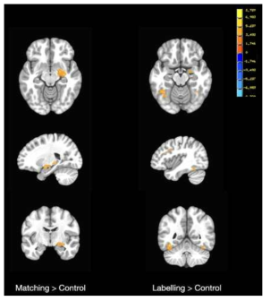 Matching 및 Labelling 조건에서 청년기 우울증 고위험군 뇌 영역 활성화 패턴