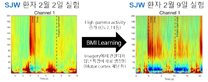운동 상상 훈련 뒤 SJW 환자의 Motor cortex 채널에서 관찰된 파형의 변화