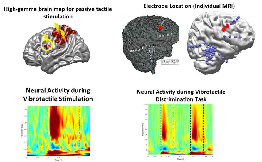 (왼쪽 위) 촉감각 자극에 대한 뇌지도, (오른쪽 위)개별 환자의 뇌에 대한 복측 전운동영역 뇌자극 위치, (아래)복측 전운동영역에서의 촉감각 특이적인 뇌반응