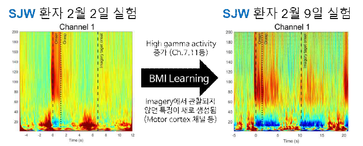 운동 상상 훈련 뒤 SJW 환자의 Motor cortex 채널에서 관찰된 파형의 변화