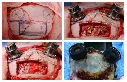 영장류 대뇌 전극 어레이 삽입 수술 사진. 일차운동피질 (좌), 후두정엽 (우)에 96채널 전극 어레이 삽입