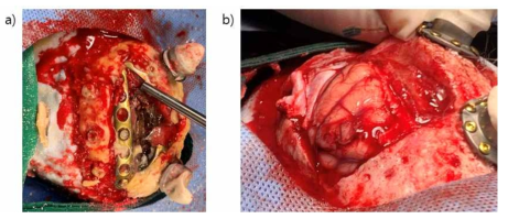 영장류 감염 검사 및 전극 삽입 수술 장면. a) 검은색 부분은 뼈가 감염된 부분. 두개골 뼈가 망실되어 전극이 뇌에서 빠져 있었음. b) 전극 삽입 수술 중 뇌부종이 온 상태