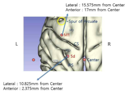 자기공명영상이미지(MRI)를 통한 3차원 뇌 시뮬레이션 및 미세 전극 어레이 삽입 위치 선정