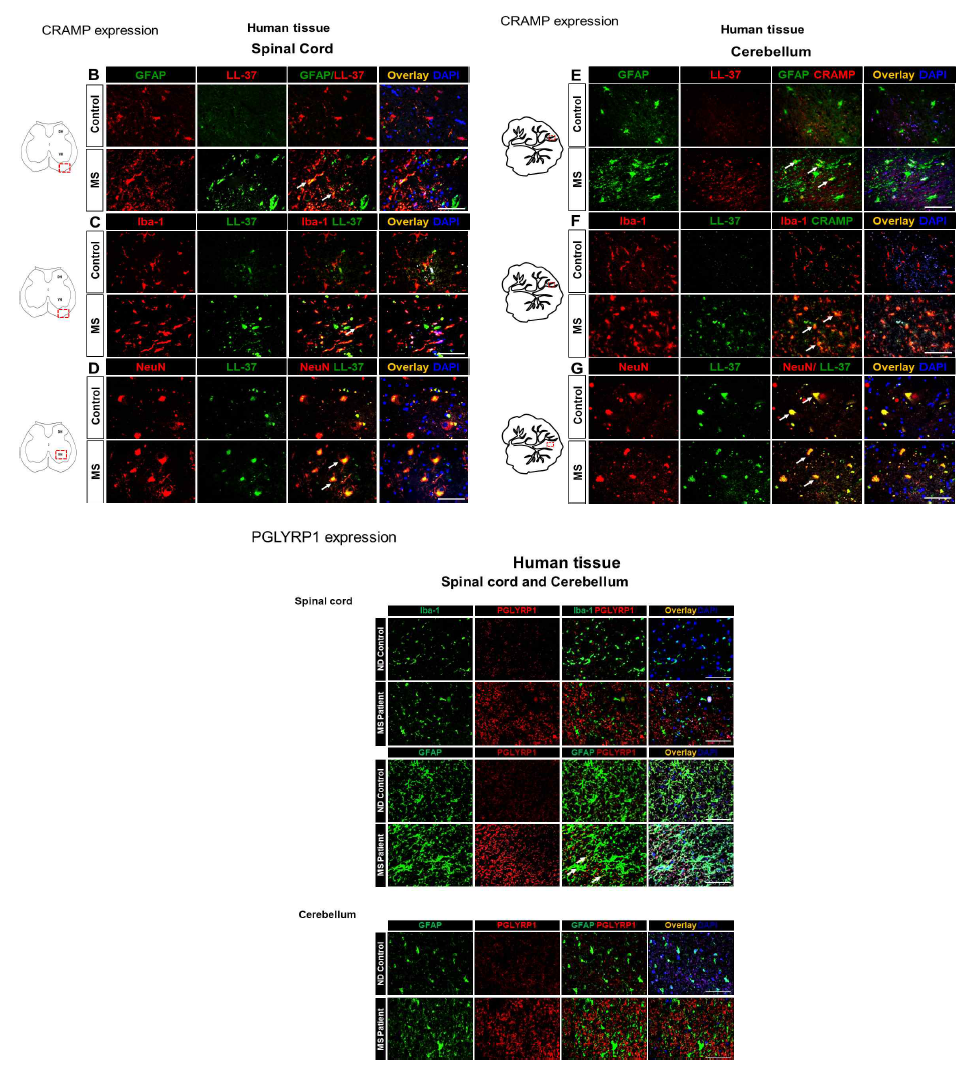 다발성 경화증 환자의 척수 및 소뇌 조직에서 cramp 및 PGLYRP1 발현
