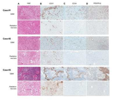Immunohistochemistry of GBM and radiation necrosis tissues for endothelial and pericyte markers
