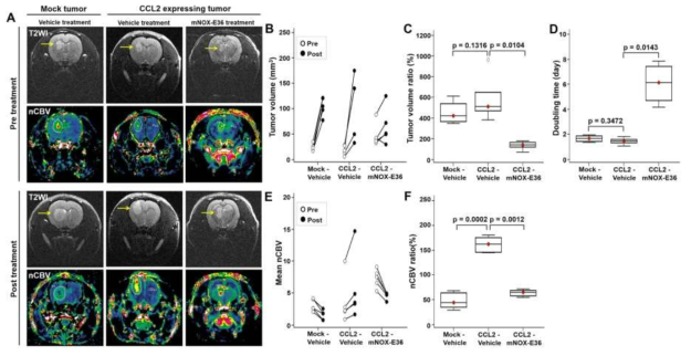 DSC (Dynamic Sysceptibility-weighted Contrast-enhanced) 관류 자기공명영상을 통한 치료법의 효과 예측