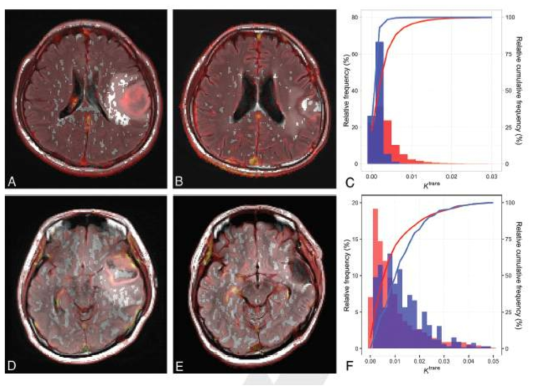 화학항암요법과 수술적 완전절제를 시행한 Glioblastoma 환자에서 수술 전후로 DCE 영상