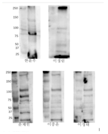 환자 sample Western Blot