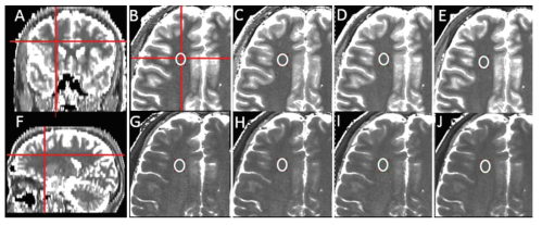 Multidyanamic multiecho (MDME) 뇌자기영상을 활용한 단면두께 차이