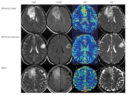 고악성도 신경아교종 (high-grade glioma) 환자들 중 isocitrate dehydrogenase 돌연변이 (IDHmut)가 있는 경우 종양 부피가 크고, nCBF가 낮고, nADC가 높음을 확인