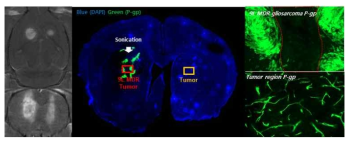다중약물내성단백질 P-glycoprotein 과발현 뇌암 동물모델 구축 및 초음파를 이용한 BBB 개통에 따른 P-glycoprotein 뇌단백질 조절 확인