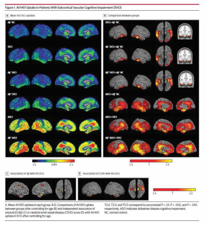 혈관성인지저하에서 tau 의 extent 와 역할에 대한 연구 JAMA neurology 2018