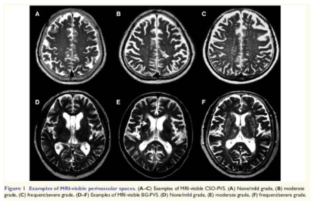 perivascular space의 해부학적 분포 패턴에 대한 연구 Brain 2017
