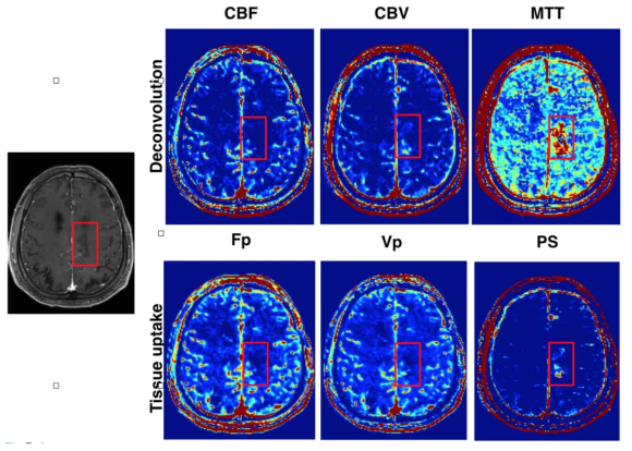 고해상도 동적 MRI 영상으로부터 추출한 정량화 수치 (CBF: blood flow, CBV: blood volume, MTT: mean transit time, Fp: plasma flow, vp: plasma volume fraction, PS: permeability surface area product)