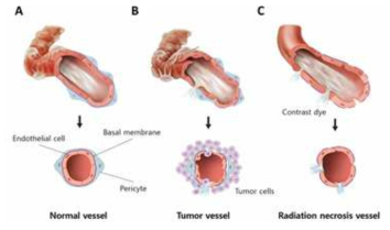 Schematic illustration of vascular structures in normal brain, glioblastoma and radiation necrosis. a Normal vessel with intact endothelial cell, basal lamina, and pericyte. b Tumor vessel in glioblastoma shows disorganized shapes such as abnormal patterns of pericytes, weak association between endothelial cells, and irregular basal membrane. These morphological alterations in tumor vessels are associated with tight junction disruption, which are reasons for the contrast-enhancement in MRI in tumor tissue. c Vessel in radiation necrosis shows loss of pericytes resulting in defects in vessel integrity which can be the cause for leakage of contrast dye