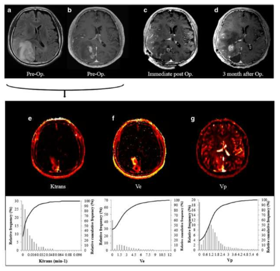 (Kim R, Choi SH, et al, Eur Radiol, 2016). 실제 분석의 예. 뇌교모세종환자에서 DCE MRI를 얻으후 조영증강 부위 및 T2 고신호 부위에서 Ktrans, Ve, Vp parameter map의 히스토그램 분석을 하여, 병변의 예후를 예측함. Ktrans, Ve, Vp parameter 값이 증가할수록 예후가 나쁘며, 이는 BBB 변성과 종양 침투의 연관성을 제시하는 자료임