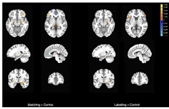 Matching 및 Labelling 조건에서 주요우울장애군 뇌 영역 활성화 패턴