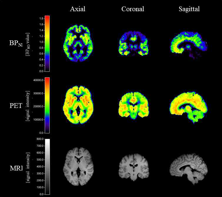 [11C]ABP688 PET 분자뇌영상 기반 글루타메이트 수용체 결합능/가용성 정량화 영상