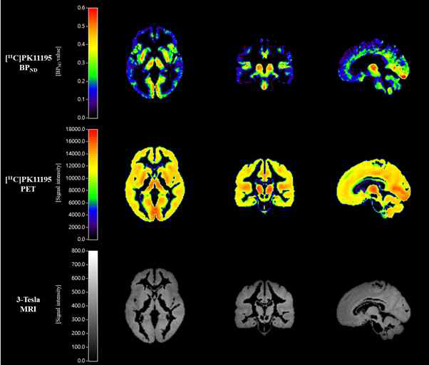 [11C]PK11195 PET 분자뇌영상 기반 대뇌염증관련 단백질 밀도/가용성 정량화 영상