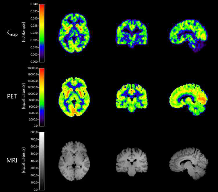 [11C]GR205171 PET 분자뇌영상 기반 뉴로키닌-1 수용체 가용성 정량화 영상
