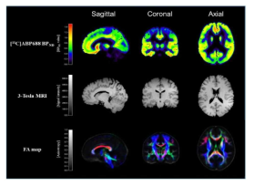 글루타메이트 수용체 분자뇌영상과 분획 이방성(FA)영상
