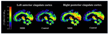 [11C]PK11195 PET 분자뇌영상 기반 대뇌염증관련 단백질 밀도 군간 영상