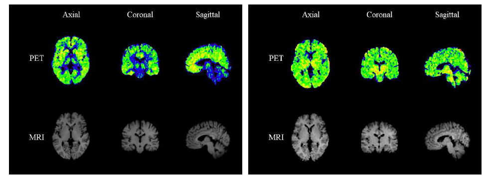 동일 연구대상자의 [11C]ABP688 (좌) 및 [11C]PK11195 (우) 다중 분자뇌영상