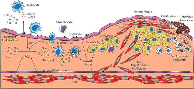 Development of atherosclerosis in endothelial cells