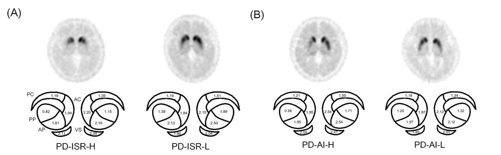 Striatal dopamine depletion 패턴 예시. (A) ISR이 클수록 posterior putamen의 DAT activity는 다른 sub-region보다 더 많이 떨어짐. (B) AI가 클수록 좌우의 비대칭이 큼
