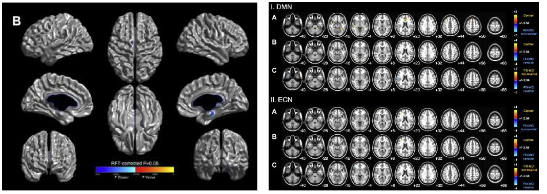 (좌) Reverter vs. Non-reverter 그룹간 피질 두께 비교. (우) 그룹간 functional connectivity 비교
