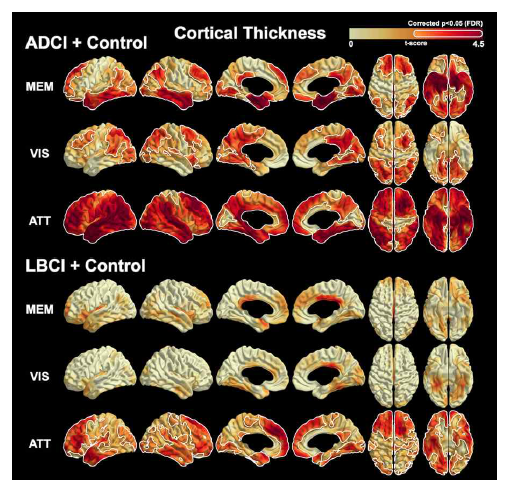 ADCI 환자와 LBCI 환자에서 인지기능과 관련된 neural correlate. MEM = memory function, VIS = visuospatial function, ATT = attention/executive function