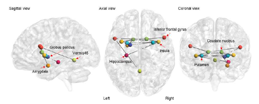 각 환자들의 motor reserve와 상관관계를 가지는 functional brain network (primary threshold P < 0.001)