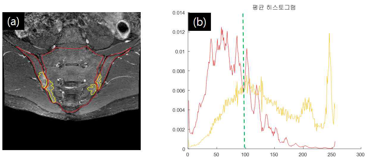 꼬리뼈 및 골반 영역과 병변 영역에 대한 픽셀 밝기 값 분포. (a) 빨간색: 꼬리뼈 및 골반 영역. 노란색: 병변 영역. (b) 빨간색: 꼬리뼈 및 골반 영역 픽셀 밝기 분포. 노란색: 병변 영역 픽셀 밝기 분포. 초록점선: 병변 영역 판별 기준 값