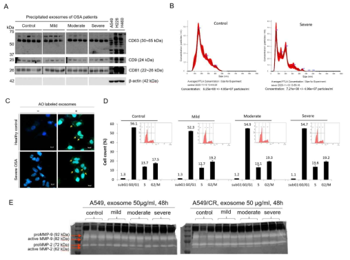 OSA 환자 유래 엑소좀이 폐암 세포주에 미치는 영향. A: 웨스턴 블럿을 통한 엑소좀 마커 CD81의 확인, B: 나노 입자 추적 분석을 통한 엑소좀 입자의 시각화, C: 엑소좀 입자의 A549 세포주 내로의 흡수, D: OSA 환자 유래 엑소좀이 A549 세포주의 세포주기에 미치는 영향, E: 엑소좀이 A549 와 A549/CR 세포주의 MMPs 활성에 미치는 영향