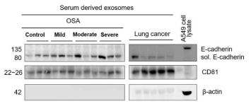 OSA 엑소좀 및 폐암환자 엑소좀 내 soluble E-cadherin의 발현 양상 비교 (Control: 정상인, Mild: 경증도 OSA, Moderate : 중등도 OSA, Severe: 중증 OSA)