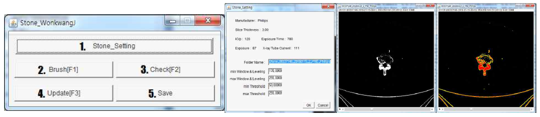 소프트웨어 메인 화면과 요로결석 의료영상의 전처리 조건 설정